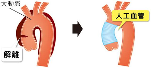 急性A型大動脈解離に対する緊急人工血管置換術の画像