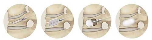 骨セメントを使用した椎体形成手術画像1