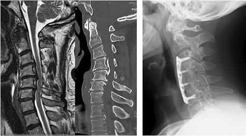 頸椎後縦靭帯骨化症に対する頸椎の前方除圧固定術画像