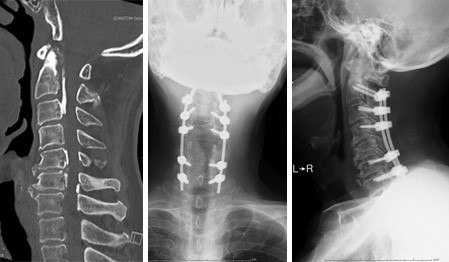 頸椎後縦靭帯骨化症に対する頸椎の後方除圧固定術画像