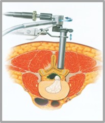 MED（Micro Endoscopic Discectomy:従来の内視鏡下椎間板切除術）画像2