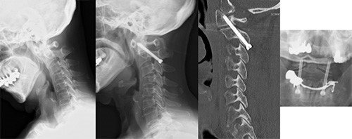 関節リウマチによる環軸椎亜脱臼の症例画像