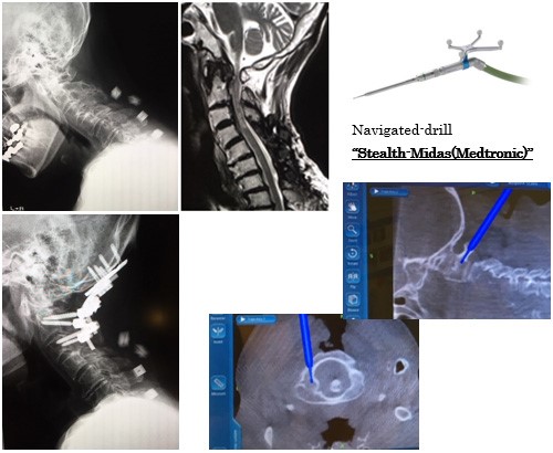 透析に伴う、環軸椎亜脱臼、歯突起後方偽腫瘍に対する頸椎後方除圧固定術画像
