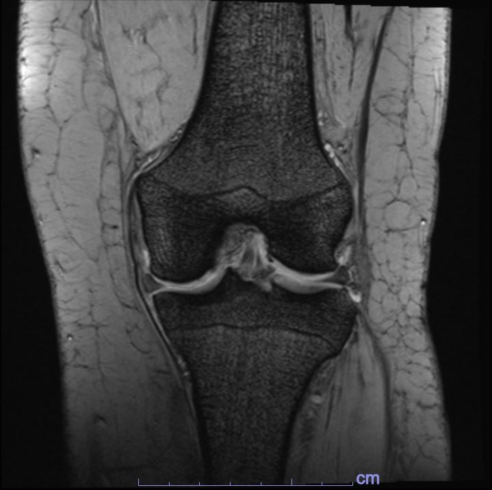 膝関節T2 medic画像