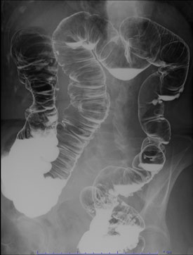 大腸（注腸）検査画像