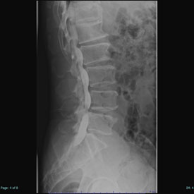 ミエログラフィー 脊髄腔造影画像