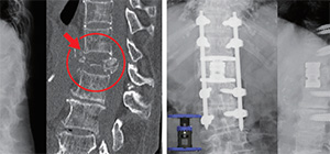 左が手術前、右が椎体形成術後。人工椎体を入れて脊椎を固定している画像
