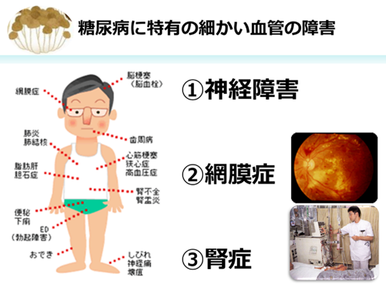 糖尿病に特有の細かい血管の障害