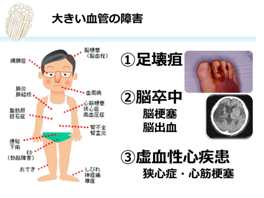 大きい血管の障害