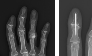 ヘバーデン結節と関節固定術後のレントゲン