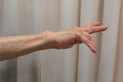 伸筋腱皮下断裂