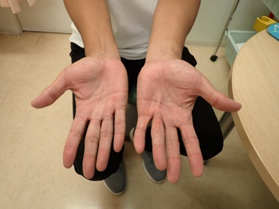 デュプイトラン拘縮