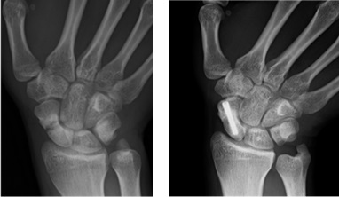 舟状骨骨折、偽関節