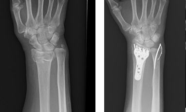 尺骨突き上げ症候群