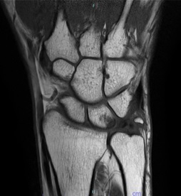 橈骨遠位端骨折、尺骨茎状突起骨折